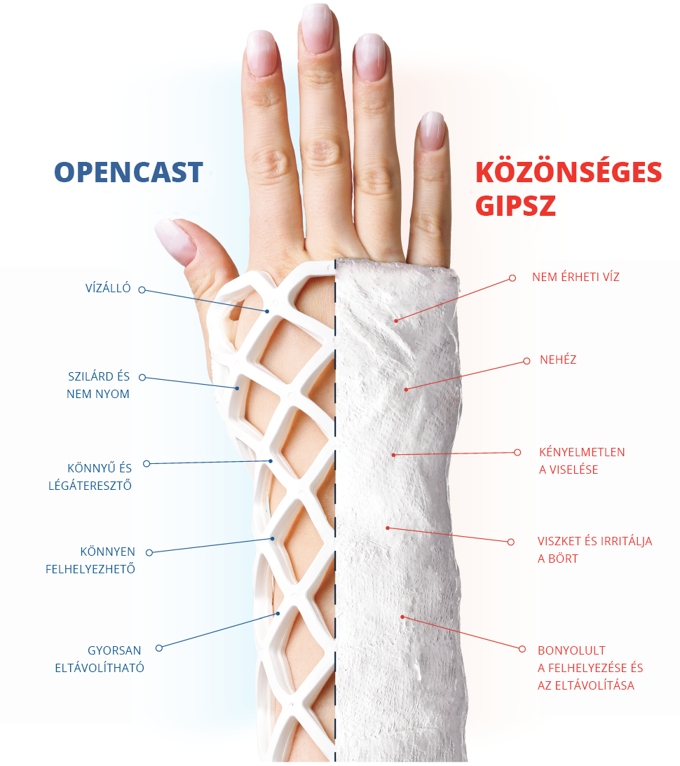 Běžná sádra vs OPEN CAST